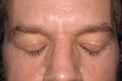 Eyelid Surgery - Blepharoplasty - Lower Eyelids Before & After Patient #5475