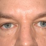 Eyelid Surgery - Blepharoplasty - Lower Eyelids Before & After Patient #5475