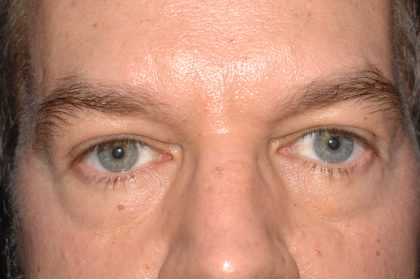 Eyelid Surgery - Blepharoplasty - Lower Eyelids Before & After Patient #5475