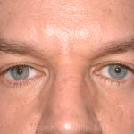 Eyelid Surgery - Blepharoplasty - Lower Eyelids Before & After Patient #5475