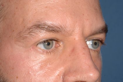 Eyelid Surgery - Blepharoplasty - Lower Eyelids Before & After Patient #5475