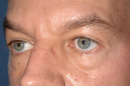 Eyelid Surgery - Blepharoplasty - Lower Eyelids Before & After Patient #5475