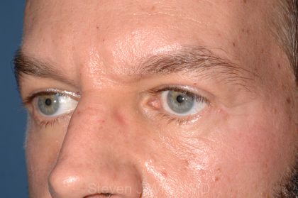 Eyelid Surgery - Blepharoplasty - Lower Eyelids Before & After Patient #5475
