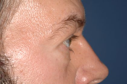 Eyelid Surgery - Blepharoplasty - Lower Eyelids Before & After Patient #5475