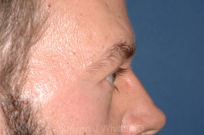 Eyelid Surgery - Blepharoplasty - Lower Eyelids Before & After Patient #5475