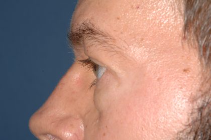 Eyelid Surgery - Blepharoplasty - Lower Eyelids Before & After Patient #5475
