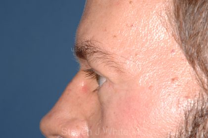 Eyelid Surgery - Blepharoplasty - Lower Eyelids Before & After Patient #5475