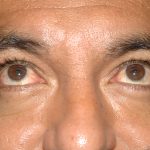 Eyelid Surgery - Blepharoplasty - Lower Eyelids Before & After Patient #5476