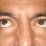 Eyelid Surgery - Blepharoplasty - Lower Eyelids Before & After Patient #5476