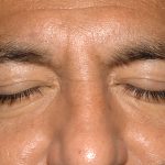 Eyelid Surgery - Blepharoplasty - Lower Eyelids Before & After Patient #5476