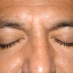 Eyelid Surgery - Blepharoplasty - Lower Eyelids Before & After Patient #5476