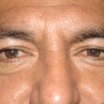 Eyelid Surgery - Blepharoplasty - Lower Eyelids Before & After Patient #5476
