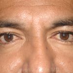 Eyelid Surgery - Blepharoplasty - Lower Eyelids Before & After Patient #5476