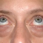 Eyelid Surgery - Blepharoplasty - Lower Eyelids Before & After Patient #5477