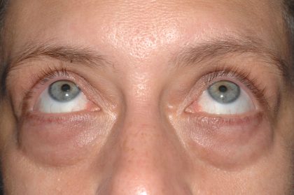 Eyelid Surgery - Blepharoplasty - Lower Eyelids Before & After Patient #5477