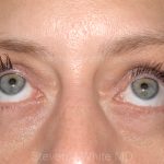 Eyelid Surgery - Blepharoplasty - Lower Eyelids Before & After Patient #5477