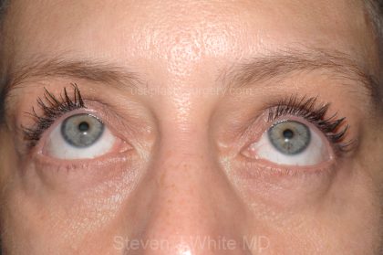 Eyelid Surgery - Blepharoplasty - Lower Eyelids Before & After Patient #5477