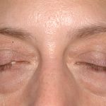 Eyelid Surgery - Blepharoplasty - Lower Eyelids Before & After Patient #5477