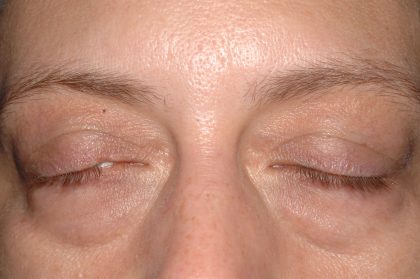 Eyelid Surgery - Blepharoplasty - Lower Eyelids Before & After Patient #5477