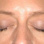 Eyelid Surgery - Blepharoplasty - Lower Eyelids Before & After Patient #5477