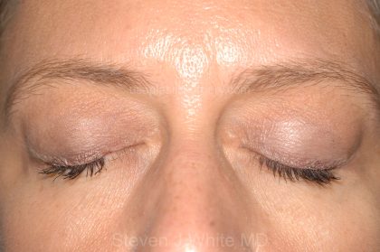 Eyelid Surgery - Blepharoplasty - Lower Eyelids Before & After Patient #5477