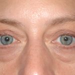 Eyelid Surgery - Blepharoplasty - Lower Eyelids Before & After Patient #5477