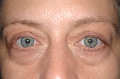 Eyelid Surgery - Blepharoplasty - Lower Eyelids Before & After Patient #5477