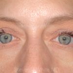 Eyelid Surgery - Blepharoplasty - Lower Eyelids Before & After Patient #5477