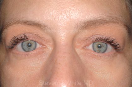 Eyelid Surgery - Blepharoplasty - Lower Eyelids Before & After Patient #5477