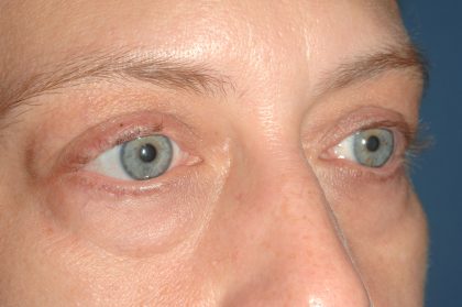 Eyelid Surgery - Blepharoplasty - Lower Eyelids Before & After Patient #5477