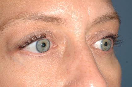 Eyelid Surgery - Blepharoplasty - Lower Eyelids Before & After Patient #5477