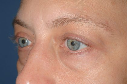 Eyelid Surgery - Blepharoplasty - Lower Eyelids Before & After Patient #5477