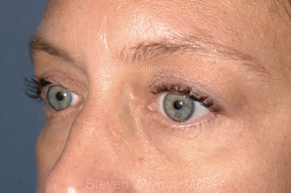 Eyelid Surgery - Blepharoplasty - Lower Eyelids Before & After Patient #5477