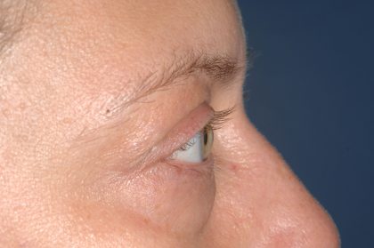 Eyelid Surgery - Blepharoplasty - Lower Eyelids Before & After Patient #5477