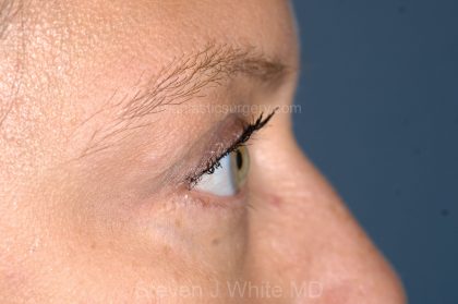 Eyelid Surgery - Blepharoplasty - Lower Eyelids Before & After Patient #5477