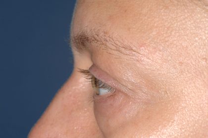 Eyelid Surgery - Blepharoplasty - Lower Eyelids Before & After Patient #5477