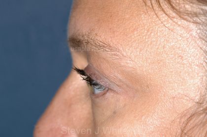 Eyelid Surgery - Blepharoplasty - Lower Eyelids Before & After Patient #5477