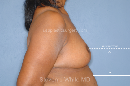 Breast Reduction Before & After Patient #7908