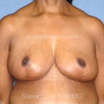Breast Reduction Before & After Patient #7908