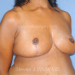 Breast Reduction Before & After Patient #7908