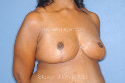 Breast Reduction Before & After Patient #7908