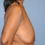 Breast Reduction Before & After Patient #7908