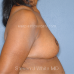 Breast Reduction Before & After Patient #7908