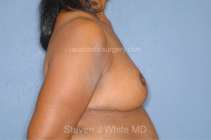 Breast Reduction Before & After Patient #7908
