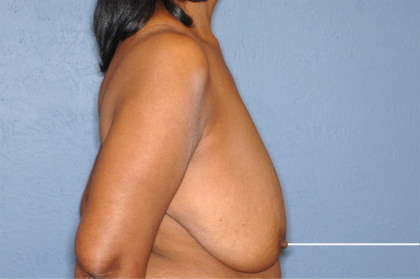 Breast Reduction Before & After Patient #7908