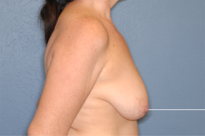 Breast Reduction Before & After Patient #7907