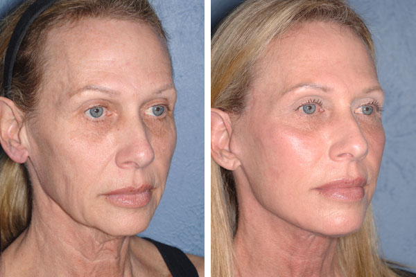 Best Plastic Surgeons in America, United States USA Best Plastic Surgeons in America One of The Worlds Best Plastic Surgeon plastic surgery before and after