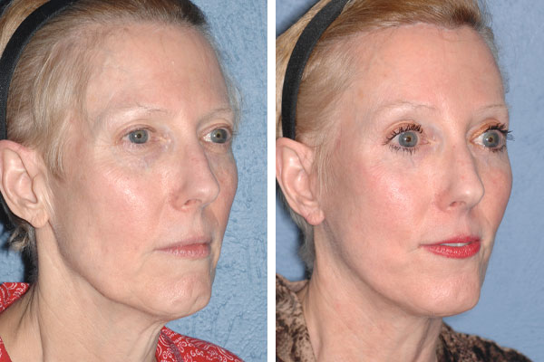 Best Plastic Surgeons in America, United States USA Best Plastic Surgeons in America One of The Worlds Best Plastic Surgeon plastic surgery before and after