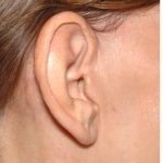 Facelift - Scar Before & After Patient #8167