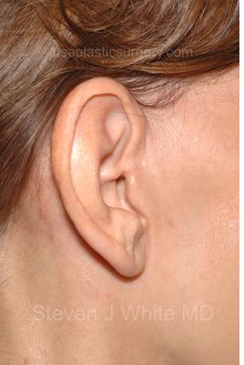 Facelift - Scar Before & After Patient #8167